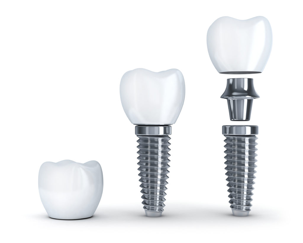 How Much Do You Know About Dental Implants? Larson Dental