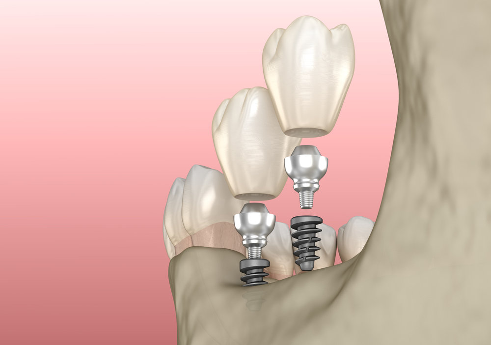 osseointegration